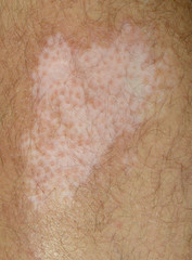 Vitiligo Spot on the Leg