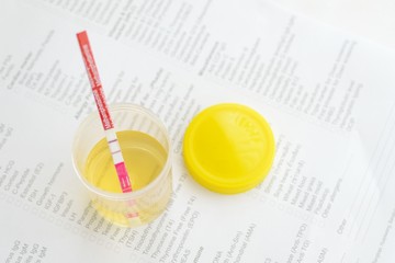 Urine amphetamine negative