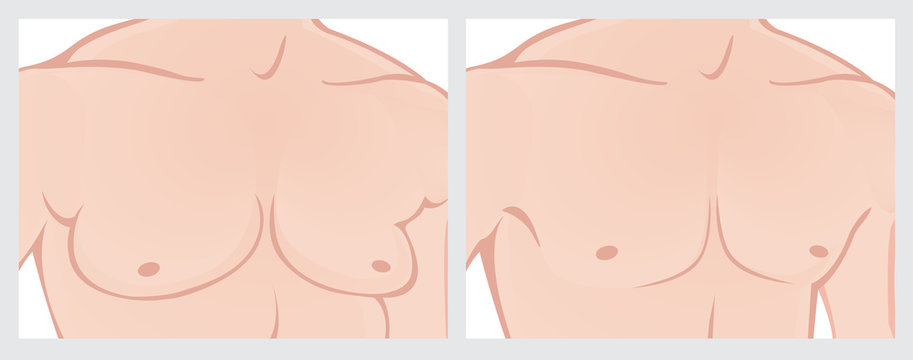 Male chest reduction