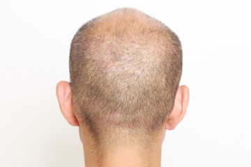 Fototapeta premium 薄毛の男性