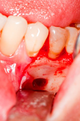 Surgical intervention