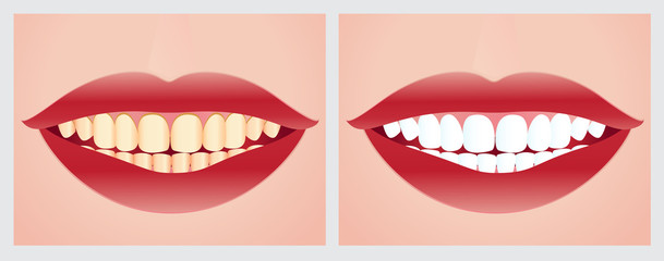 Teeth whitening before and after the treatment.