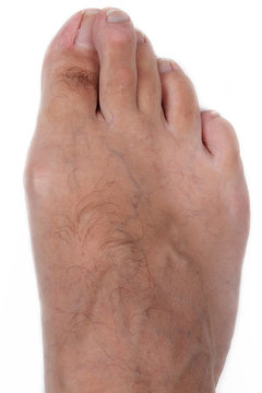 hallux valgus