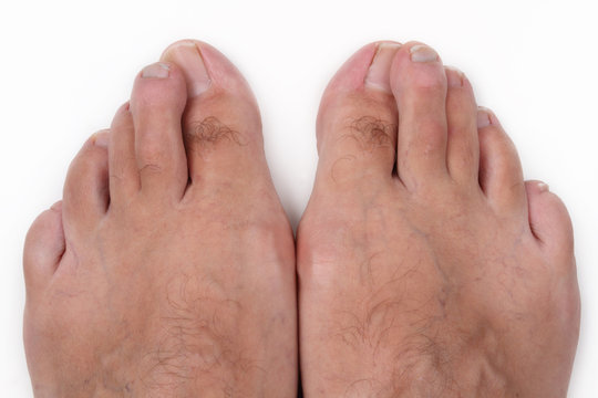 alluce valgo - hallux valgus