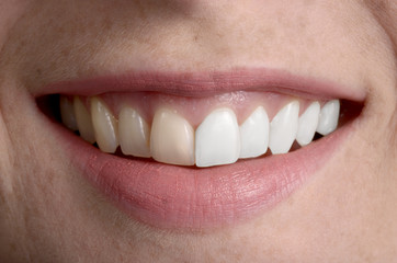 Hübsches Lächeln, Zahnpflege vorher/ nachher