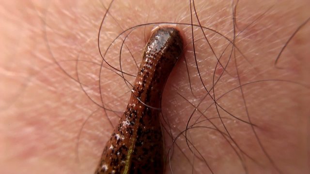 Jawed Land Leech attached to man's leg