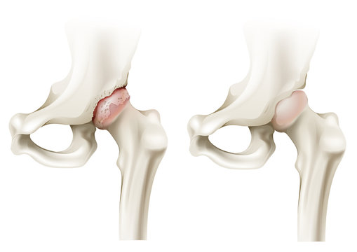 Hip Arthritis