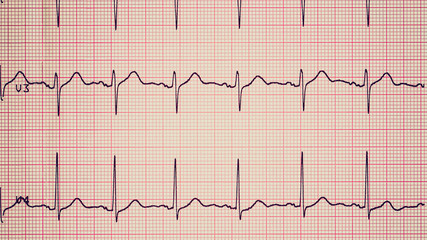 Electrocardiography of heart beat