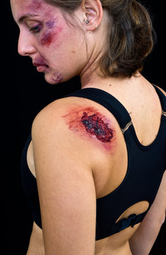 Injured Woman With Open Wound