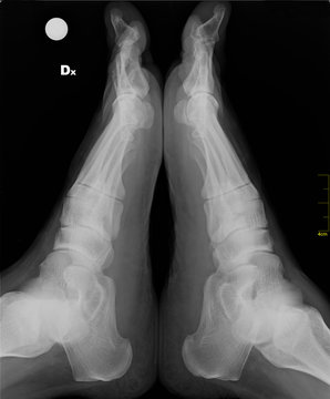 X-ray foot