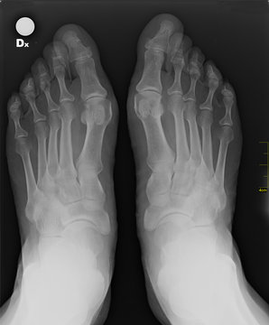 X-ray foot