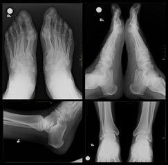 X-ray foot - obrazy, fototapety, plakaty