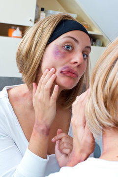 woman covered with bruises in front of the mirror