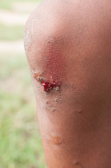 Fototapeta premium The wound on his leg