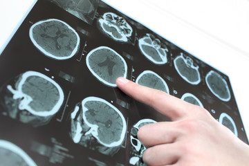 CT scan of the patient's brain and the hand of a doctor.