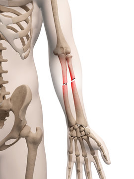 Medical Illustration Of Arm Bone