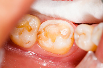 Fototapeta premium Before Treatment