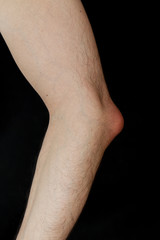 Olecranon bursitis, also known as student’s elbow