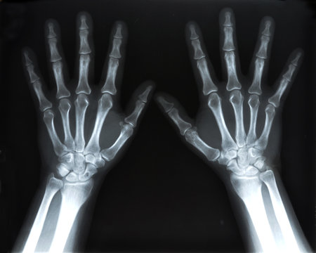X-Ray image of human hands