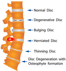 Spine. Spine conditions