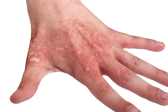 Hand a teenager with blisters due to burns hogweed