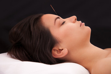 Acupuncture needle in the head