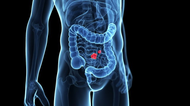 intestinal cancer
