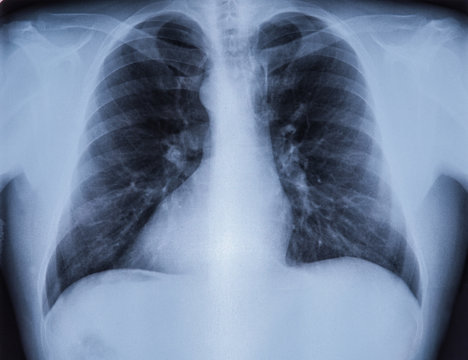 chest X-ray