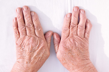 Old woman's hands geformed from rheumatoid arthritis