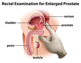 Rectal Examination for Enlarged Prostate