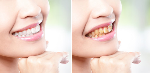 Fototapeta premium woman teeth before and after whitening