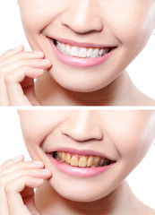 Obraz premium woman teeth before and after whitening