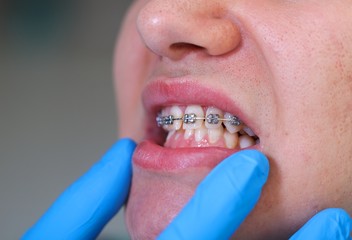 Dental braces