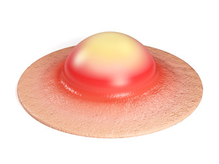 Pimple on the skin close-up. Zit isolated