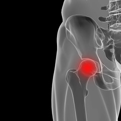 Human hip joint, showing area of pain