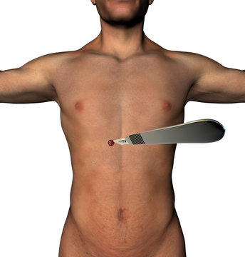 Chirurgia LESS addome incisione bisturi corpo umano
