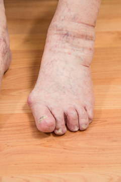 closeup of a senior person's foot with arthritis