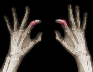 X-rays of hands of an adult man with vi