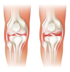 Human knee arthritis