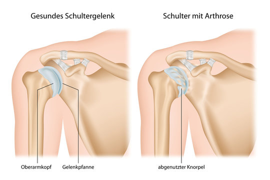 Schulter Arthrose, Omarthrose mit Erkl&auml;rung deutsch