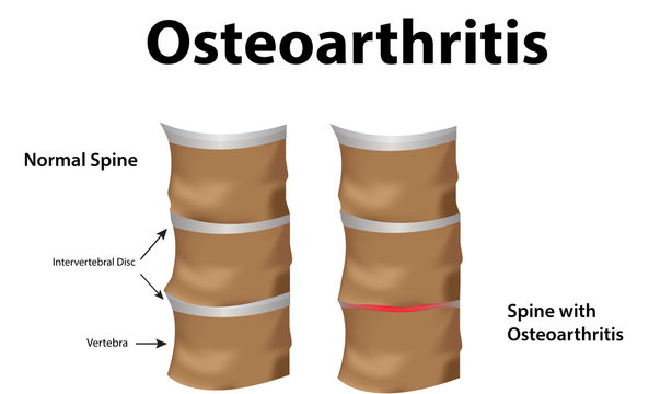 Osteoarthritis