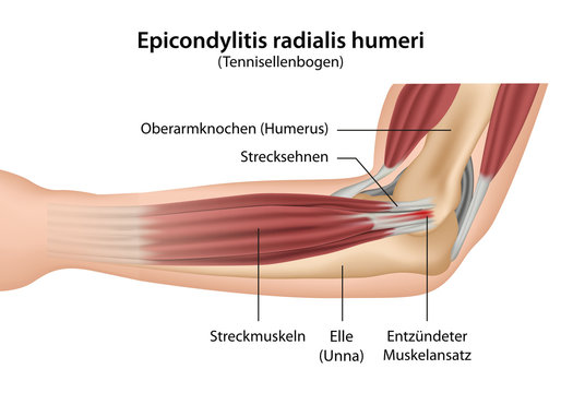 epicondylitis könyökfájdalom)