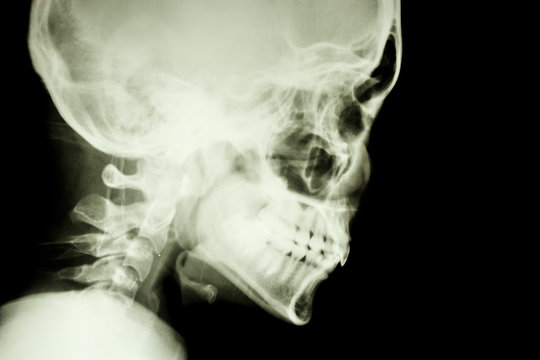 normal skull and cervical spine