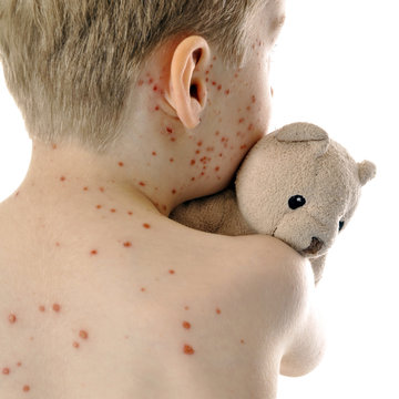 Kind mit Windpocken / Wasserpocken