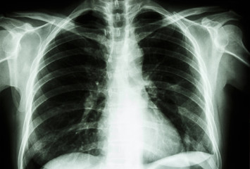 normal human's chest