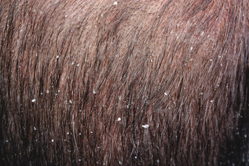 Dandruff in the hair