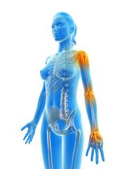 painful arm joints of a female