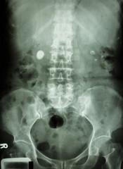 bilateral renal stone