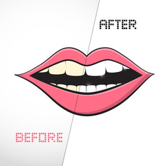 Cleaning Teeth, Before and After