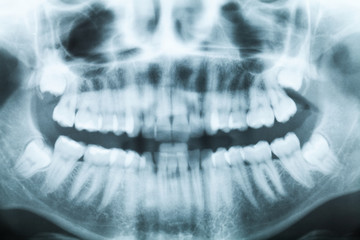 Obraz premium X-ray image of teeth and mouth with four molars